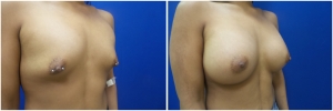 breast-implants-augmentation-19-5