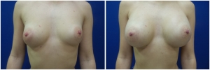 breast-implants-augmentation-before-after-20-1