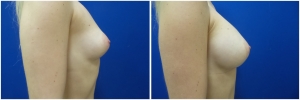 breast-implants-augmentation-before-after-20-2