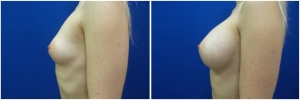 breast-implants-augmentation-before-after-20-3