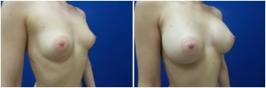 breast-implants-augmentation-before-after-20-4
