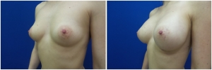 breast-implants-augmentation-before-after-20-5