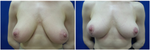RR-breast-reduction-before-after-photo-1-1