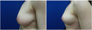 RR-breast-reduction-before-after-photo-1-2