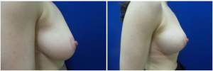 RR-breast-reduction-before-after-photo-1-3