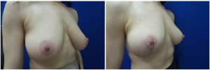 RR-breast-reduction-before-after-photo-1-4