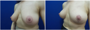 RR-breast-reduction-before-after-photo-1-5
