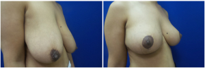 SJ-breast-reduction-before-after-photo-1-1