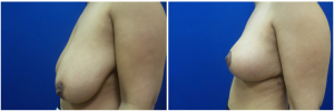 SJ-breast-reduction-before-after-photo-1-2