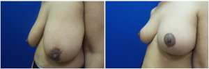 SJ-breast-reduction-before-after-photo-1-3