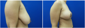 SJ-breast-reduction-before-after-photo-1-5