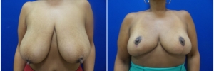 breast-reduction-3-1