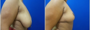 breast-reduction-3-2