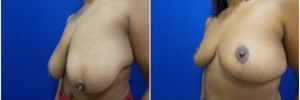 breast-reduction-3-3