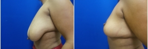 breast-reduction-3-4