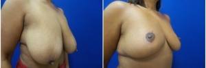 breast-reduction-3-5