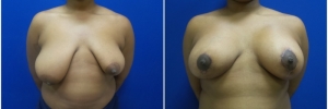 breast-reduction-4-1
