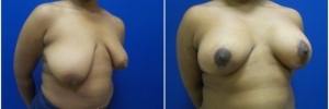 breast-reduction-4-2