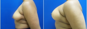 breast-reduction-4-3