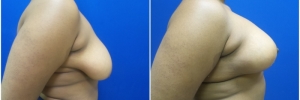 breast-reduction-4-4