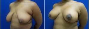 breast-reduction-4-5