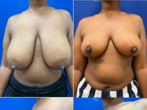 breast-reduction-plastic-surgery-nyc-before-after-photo-1