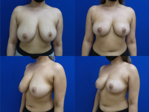 breast-reduction-plastic-surgery-nyc-before-after-photo-11