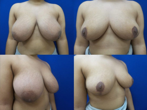 breast-reduction-plastic-surgery-nyc-before-after-photo-14