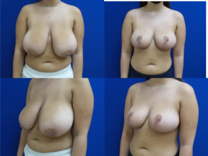 breast-reduction-plastic-surgery-nyc-before-after-photo-17