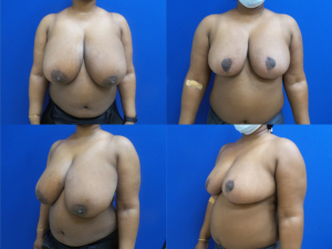 breast-reduction-plastic-surgery-nyc-before-after-photo-19