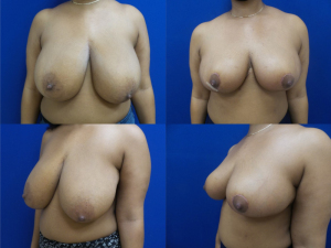 breast-reduction-plastic-surgery-nyc-before-after-photo-6