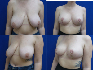 breast-reduction-plastic-surgery-nyc-before-after-photo-7