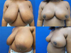 breast-reduction-plastic-surgery-nyc-before-after-photo-8