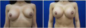 breast-revision-before-after-2-1