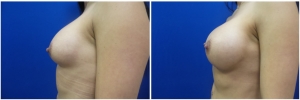 breast-revision-before-after-2-2