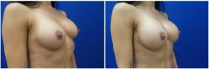 breast-revision-before-after-2-3