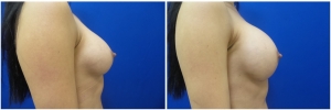 breast-revision-before-after-2-4