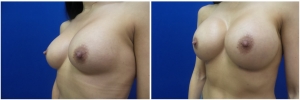breast-revision-before-after-2-5