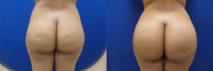 FP-buttock-implants-before-after-1-1