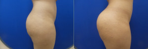 FP-buttock-implants-before-after-1-2