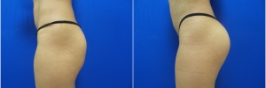 buttock-implants-1