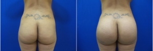 buttock-implants-1