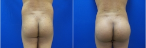 buttock-implants-1