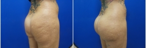 buttock-implants-10-2