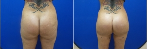 buttock-implants-10-3