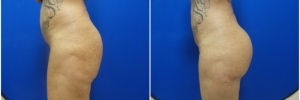 buttock-implants-10-4