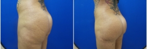 buttock-implants-10-5