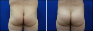 buttock-implants-12-1
