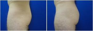 buttock-implants-12-2