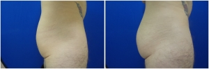 buttock-implants-12-3